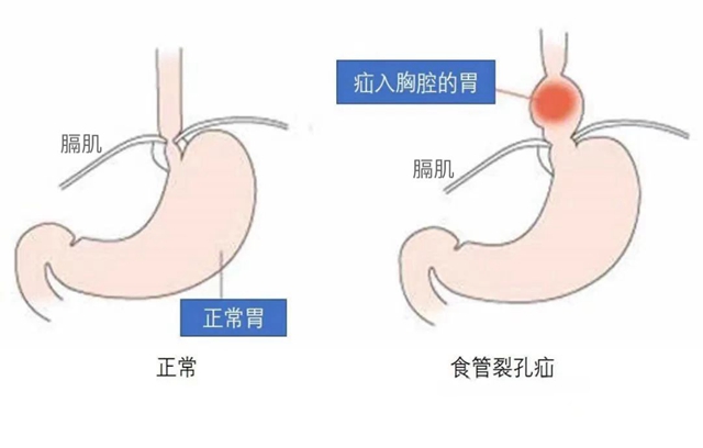 【圍觀】一吃就吐，男子胃部“竄”進了個大洞......